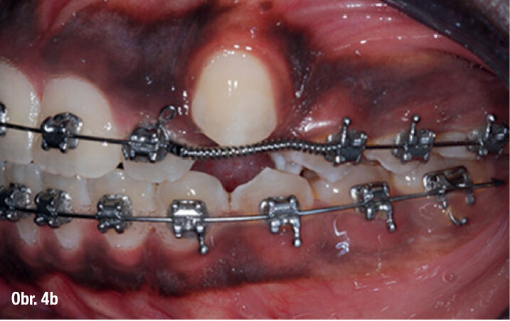 TS2 s anteriorními čtvercovými tahy a aktivními samoligovacími zámky jsou vysoce efektivní k rychlé úpravě závažných skeletálních anteriorně a laterálně otevřených skusů