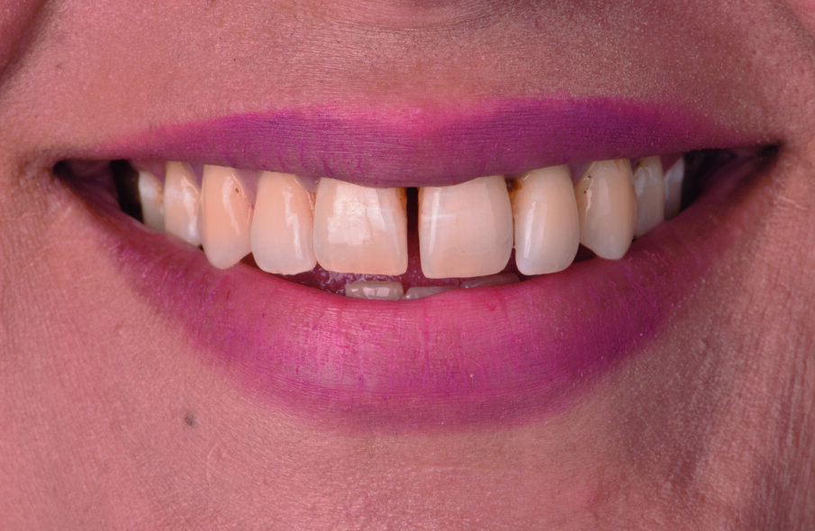 Fig 1a. Before smile rejuvenation with BioSmart restorative materials