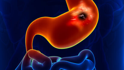 Unbehandelte Parodontitis erhöht Magenkrebsrisiko Unbehandelte Parodontitis erhöht Magenkrebsrisiko