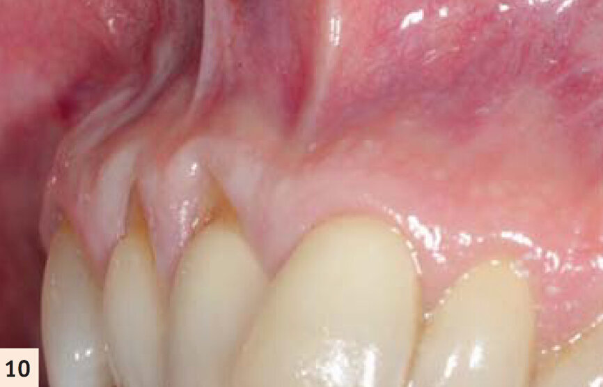figure 10 : Vues pré- et postop (2 ans). Noter l’augmentation tridimensionnelle de la zone de tissu kératinisé et attaché, ayant pour résultat la restauration de la perte d’attachement et la correction de la
déformation gingivale en hauteur et en largueur.