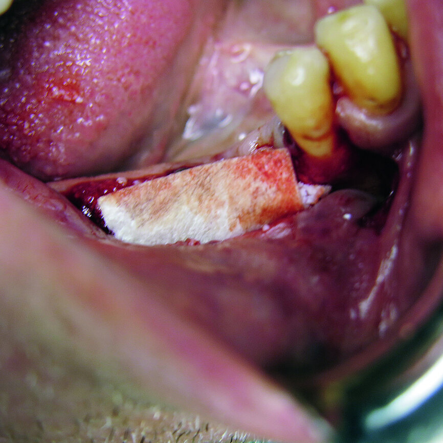 Fig. 4: Application of pericard membrane.