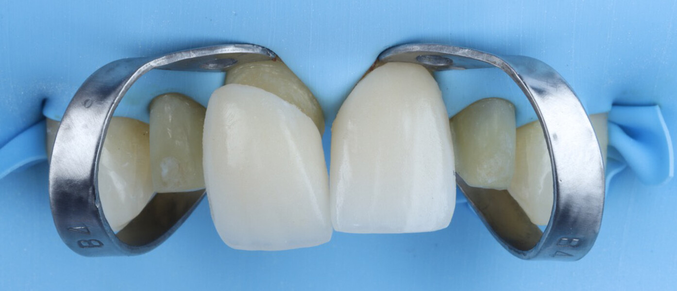 Fig. 13a: Additional retraction achieved using B4 clamps to facilitate dry try-in of the veneers.