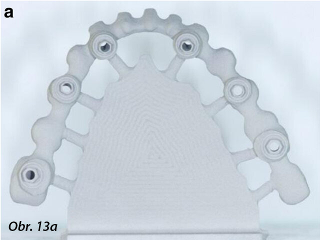 Chromkobaltová základní konstrukce vyrobená pomocí CAD/CAM jako jeden celek před (a, b) a po fazetování kompozitem (SR Nexco Paste, Ivoclar Vivadent), tedy hotovou definitivní fixní náhradu (c, d).