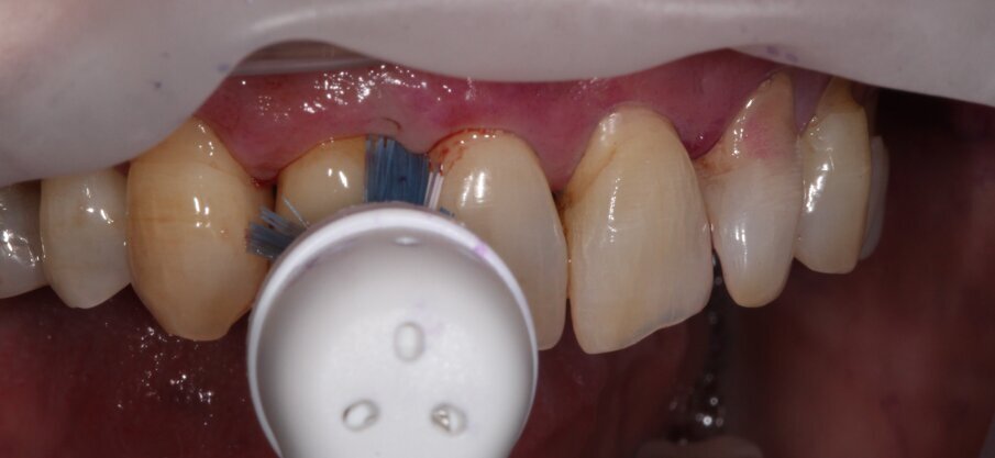 Fig.7 - Spazzolamento dell’area con la testina ultimate clean e targeted clean.