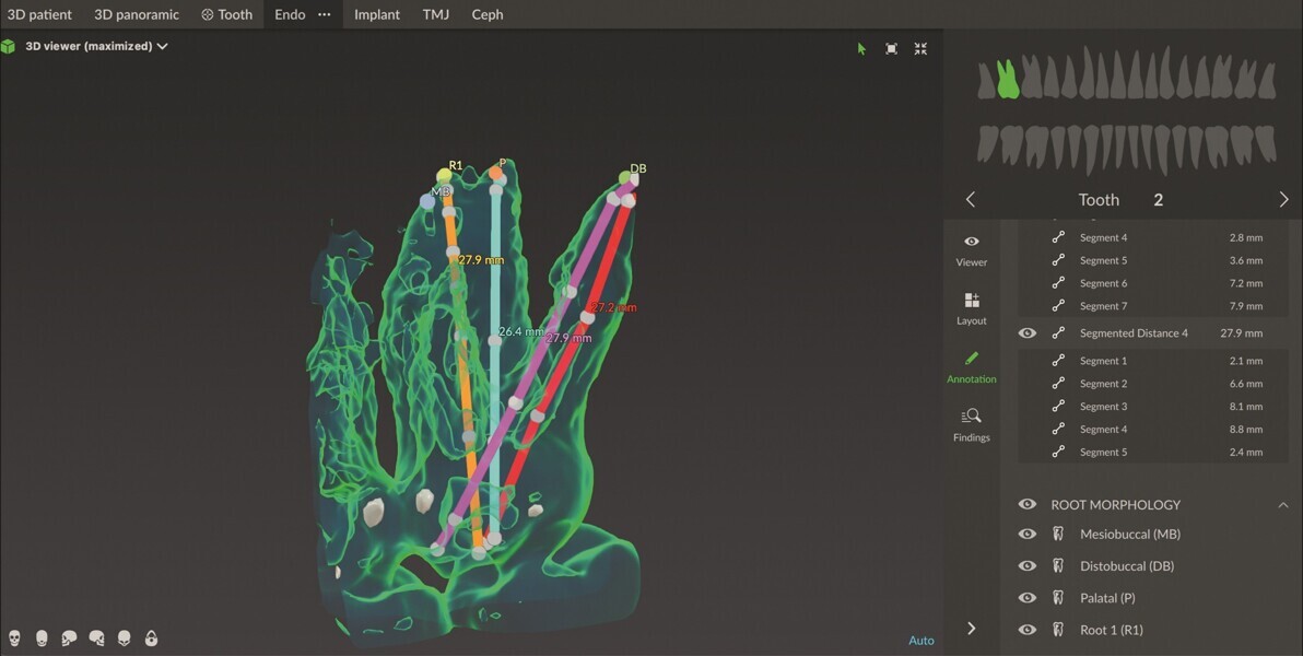 Fig. 4 : Reconstruction 3D des canaux en différentes couleurs, montrant la longueur détaillée segment par segment pour chaque canal. 