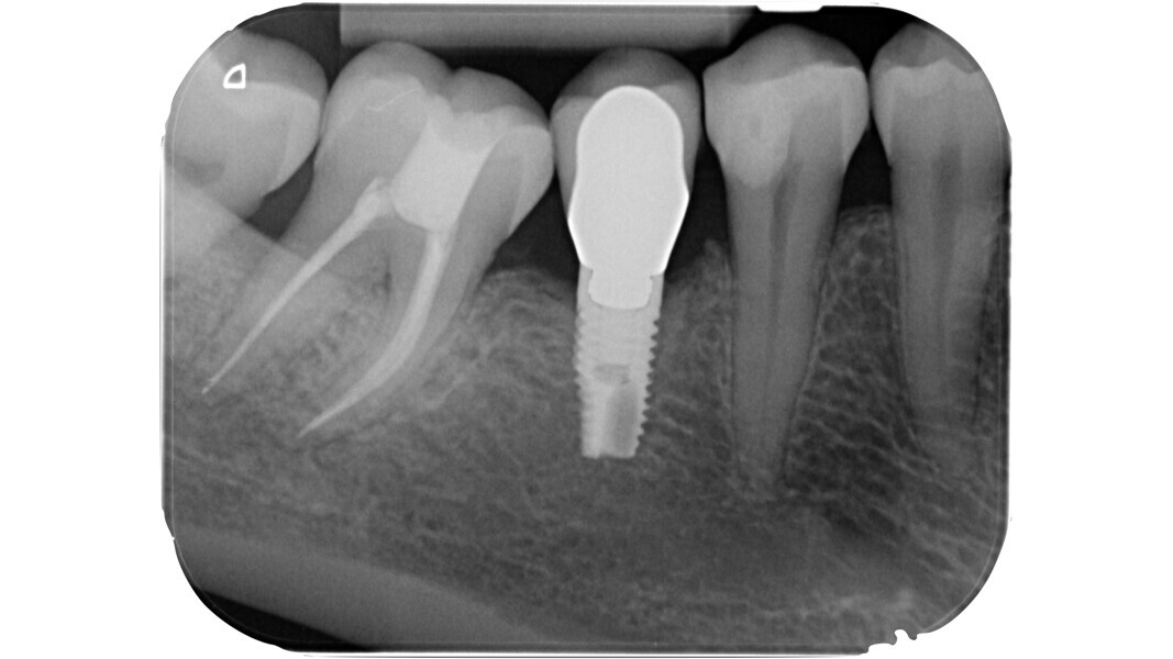 Fig. 7 : Radiographie postopératoire montrant l’axe de pénétration correct durant la préparation de la cavité d’accès.