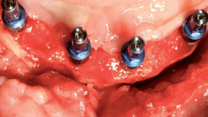 Reconstruction 3D de la crête alvéolaire chez un patient présentant une perte osseuse importante