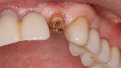 Fig. 1: The patient presented with a horizontally fractured clinical crown, an indication for a partial extraction therapy procedure.