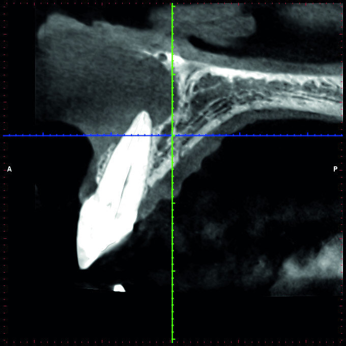 Fig. 2b: Conventional radiograph of an endodontically treated tooth #11 and cold-sensitive tooth #12 compared with CBCT imaging showing the presence of a large apical bone defect (taken at a two-day interval).