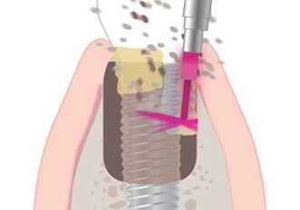 AdvErL Evo laser AdvErL Evo laser