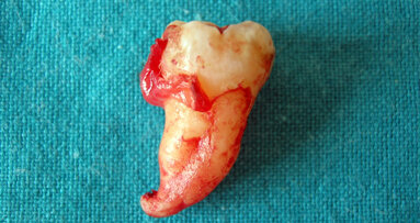 La chirurgia dell’ottavo inferiore: diagnosi, indicazioni cliniche e valutazione degli esiti negativi
