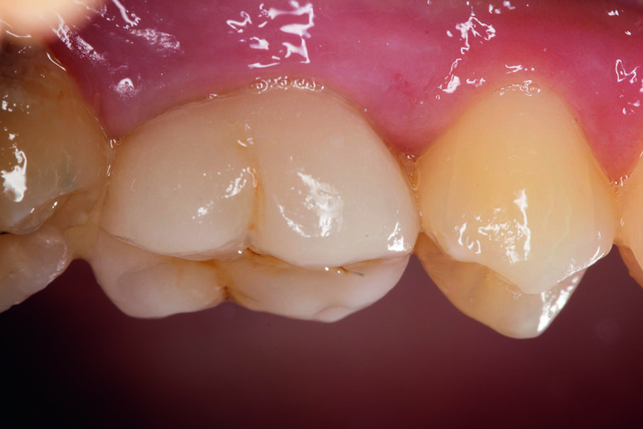 Fig. 12: The crown was light-cured from each side.