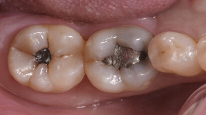 Amalgam replacement with flowable composite