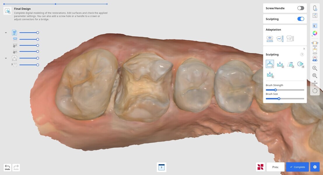 Fig. 7: Intra-oral scan of the prepared tooth in Medit ClinicCAD.