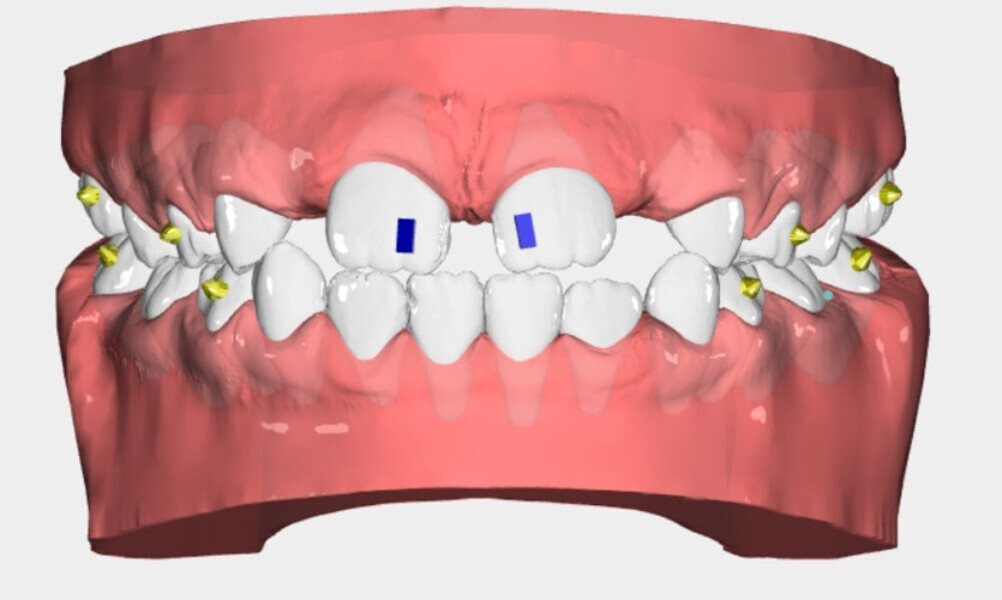Fig. 8a: Nuvola View images of the impressions for the first phase of therapy, the second phase, the finishing design and the final re-evaluation of the case.