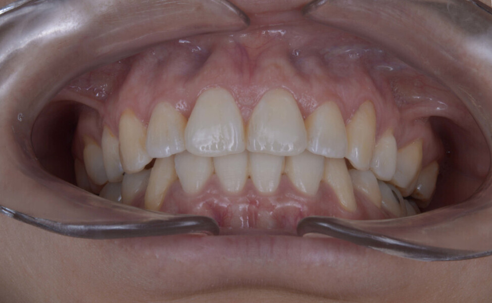 Fig. 7b: Final intra-oral photographs.