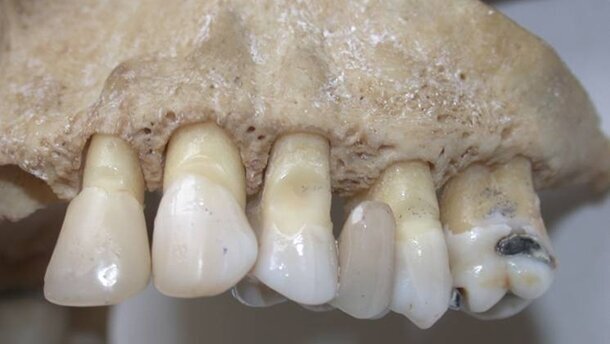 Identifizierung mittels des Gebisses