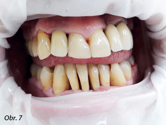 Obr. 7: Intraorální nález u pacientky při recallu