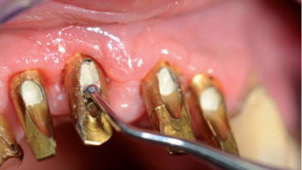 CFAO dentaire – Des piliers  sur mesure pour les patients et  une nouvelle conception d’implant