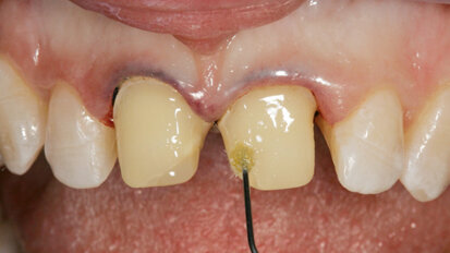 Un innovativo protocollo  di cementazione adesiva