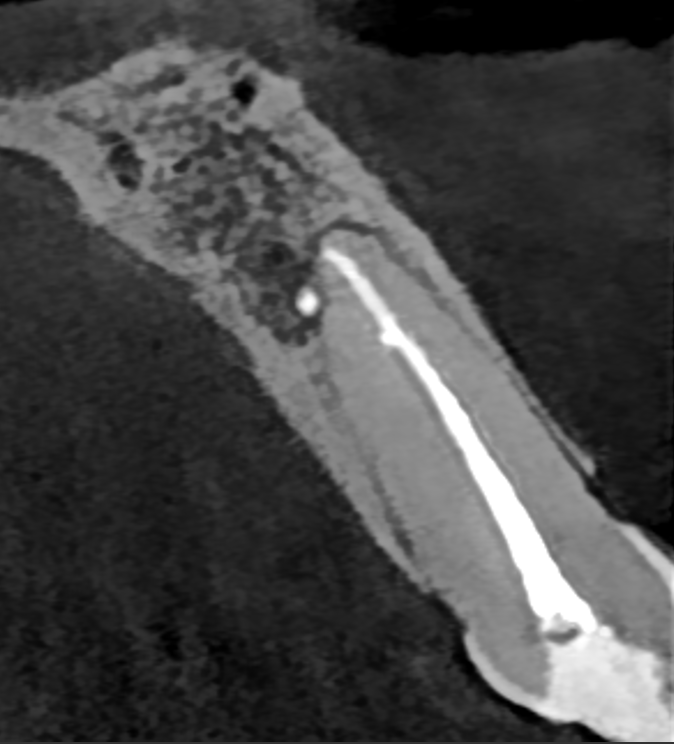 Figs. 1a & b: CBCT scan showing a second canal in the central incisor (E mode; field of view: 5 × 5 mm).