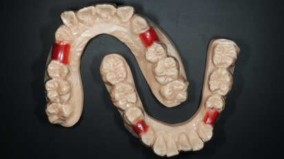 In-house 3D-printing workflows for implant restorations and Shape Memory Aligners