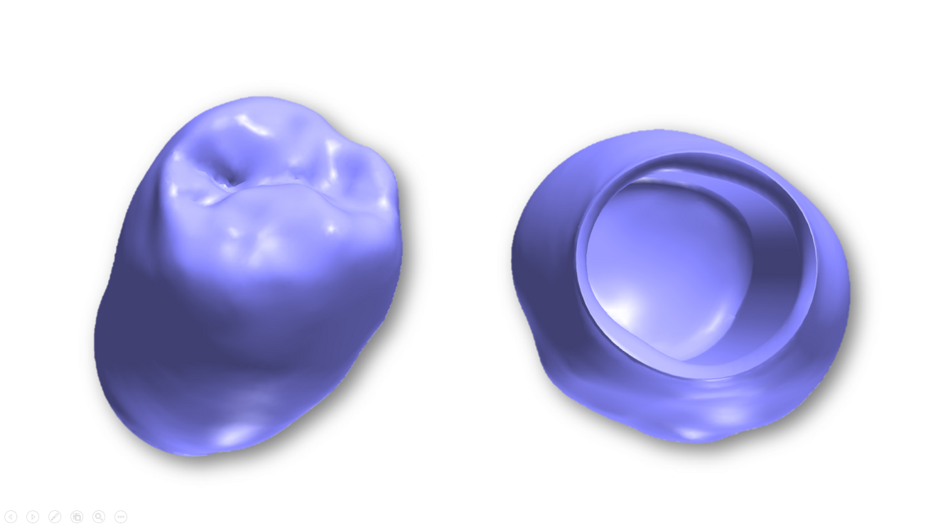 Fig. 6: STL file of the CAD of the definitive restoration.