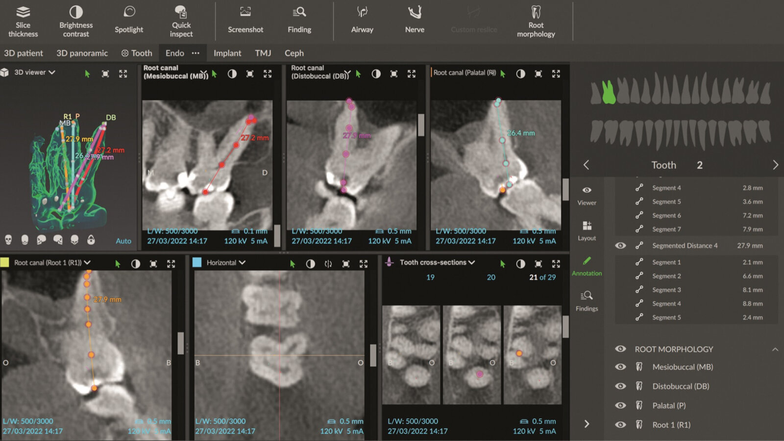 L’utilisation d’un logiciel d’imagerie numérique pour un traitement endocanalaire efficace