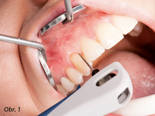 Obr. 1: Správné postavení Paro násadce při subgingiválním ošetření