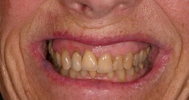 Monolithic multilayer zirconia crowns in the aesthetic zone