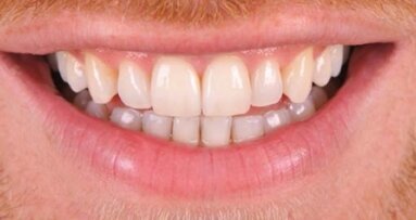 Adhesive cementing of porcelain veneers with PANAVIA V5: A clinical report