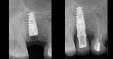 Preparace štoly pro implantát digitálním Er:YAG laserovým násadcem