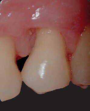 Fig. 11 - Controllo spazzolamento a 1 mese.