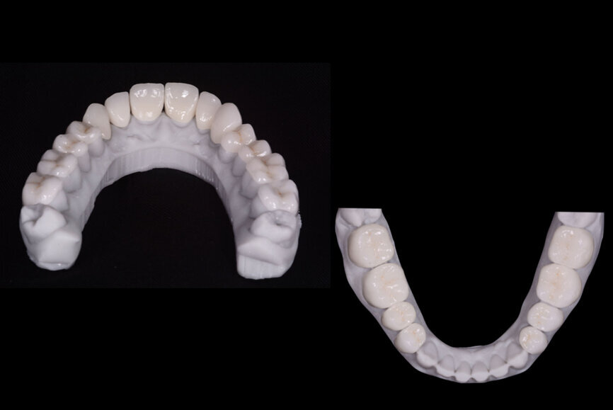 Fig. 10: Final veneers and crowns digitally prepared using the Ceramill Mind design software and produced in a milling machine (Ceramill
Motion 2) from machinable lithium disilicate ceramic blocks (VITABLOCS TriLuxe forte).