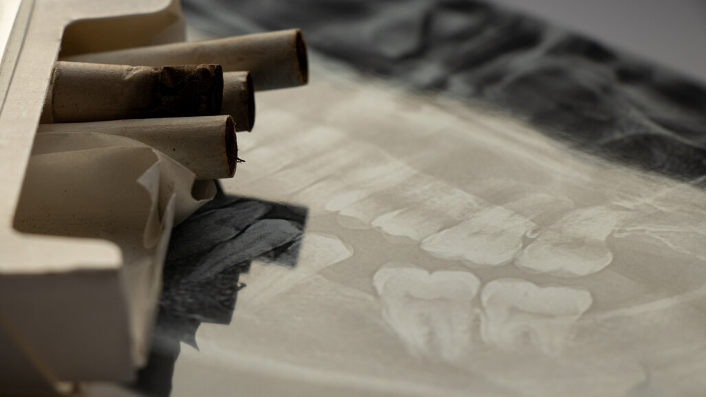 Nghiên cứu liên kết mô hình phát triển răng với tiền sử hút thuốc