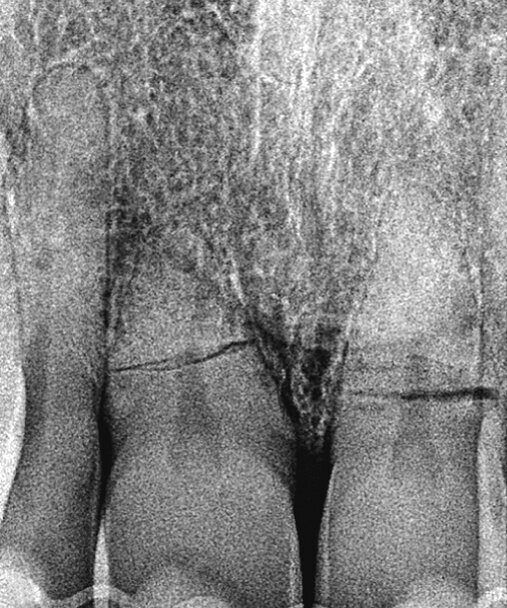 Slika 2. Početna situacija: Pojedinačne snimke zubi 11 i 21 s jasno vidljivim lomom korijena