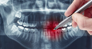 Parodontitis ist Männersache