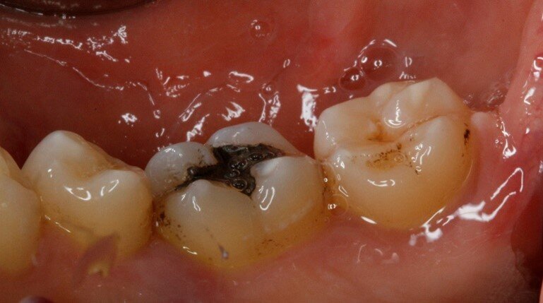 Fig. 5c - Controllo a tre mesi.