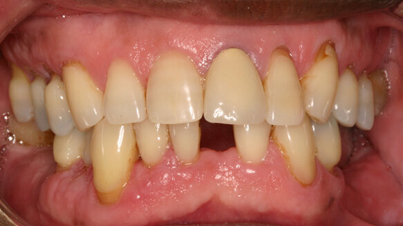 The compromised implant site solution