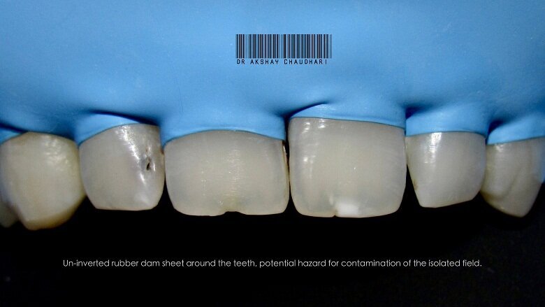 Fig - 5 Rubber dam inversion