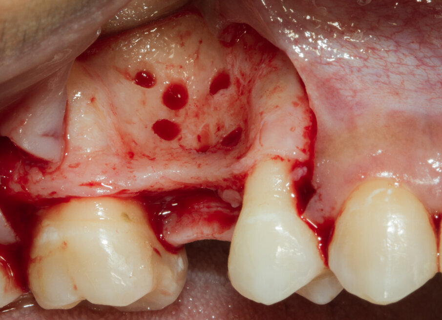 Fig. 7 - Visione vestibolare del difetto osseo.