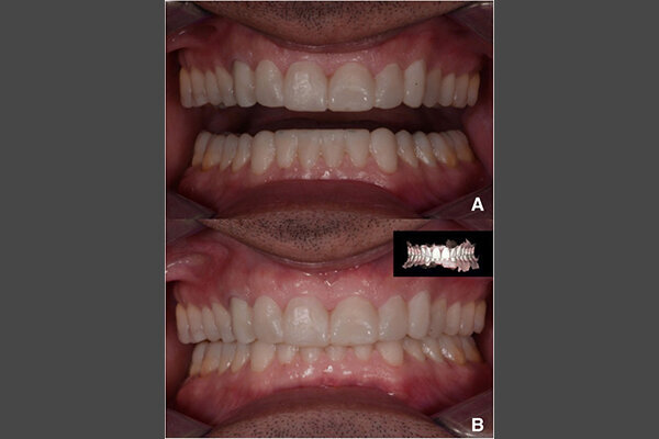 Fig. 6. a Mock-up motivacional. b Mock-up motivacional y escaneo intraoral.