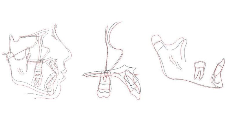 Bilateral Class I occlusion was achieved, along with coincident midlines and normal overbite and overjet. A reduction in facial convexity resulted in a pleasing soft-tissue profile. The patient’s dental alignment, smile arc, and final occlusion were all excellent. 