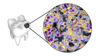 Researchers sequence rare bacterium that causes rampant dental caries