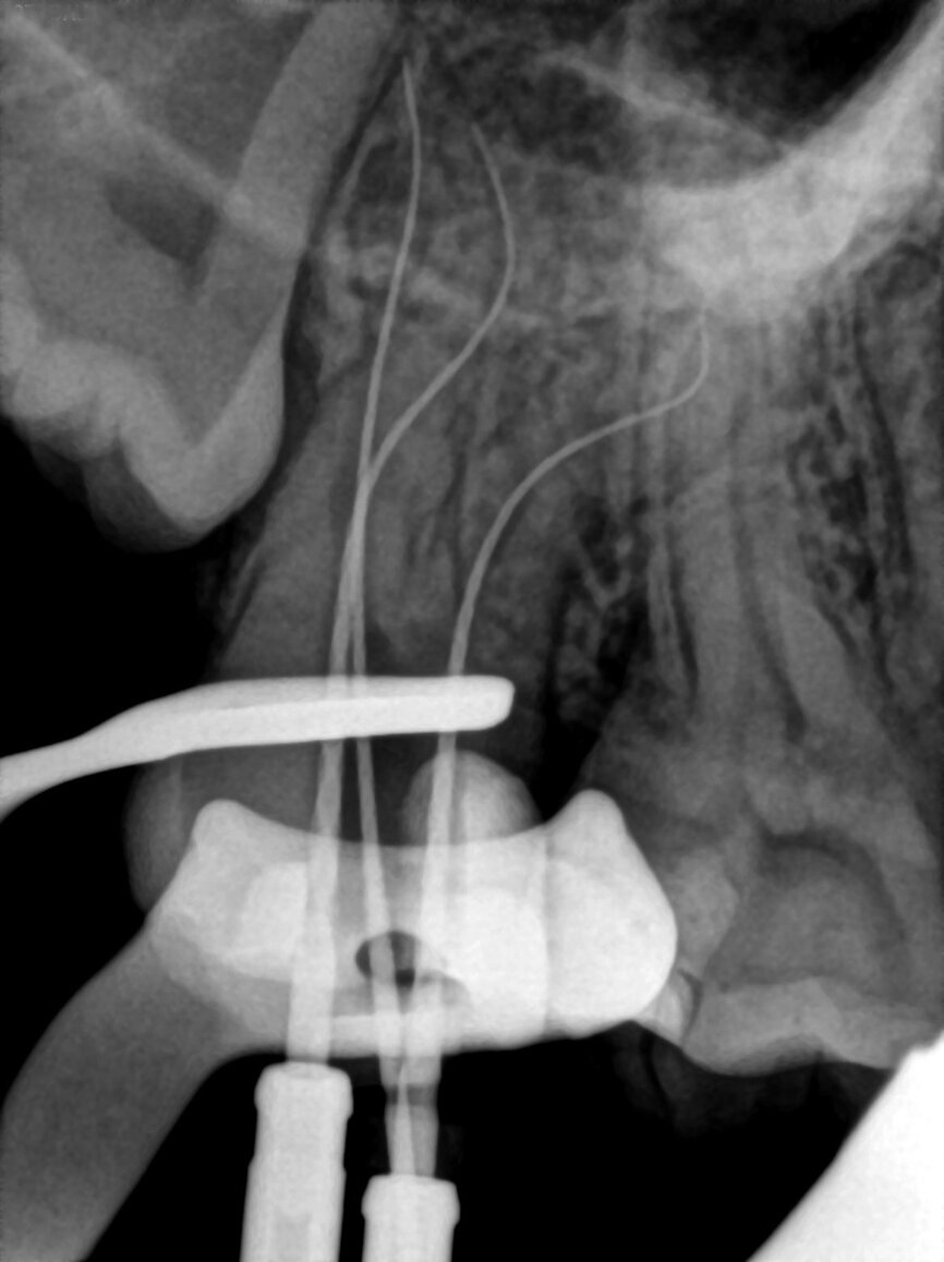 Fig. 3: Preoperative periapical radiograph showing a temporary restoration with poor marginal seal at the gingival margin.