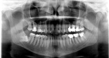 Powikłania jatrogenne w chirurgii stomatologicznej – przegląd piśmiennictwa i opis przypadków