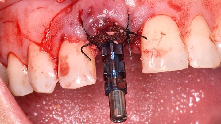 Figura 10. Colocación de las partículas de biomaterial mezcladas con sangre del paciente. Vamos aumentando el número de partículas hasta corregir el defecto, pasando de un defecto cóncavo a un volumen convexo.