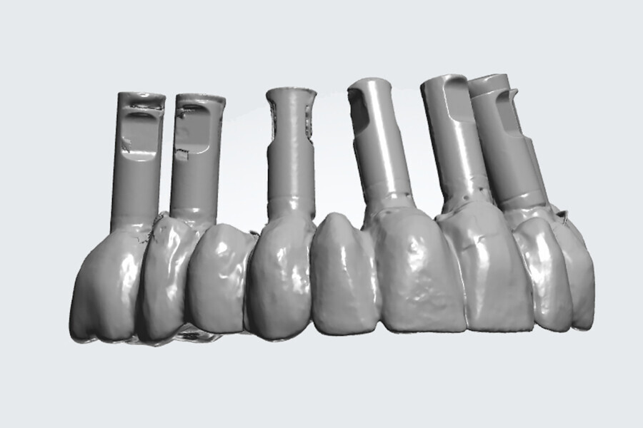 Fig. 5g: The scan of the provisional with the analogues attached.