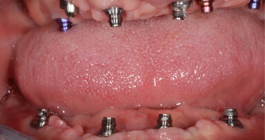 Riabilitazione di arcata mascellare edentula a carico immediato