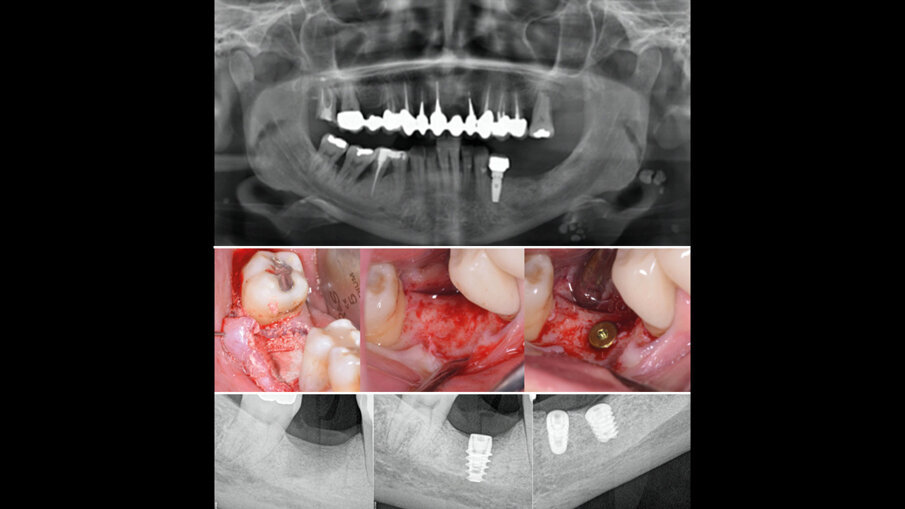 Fig. 7 - Inserimento impianti e radiografie di controllo.
